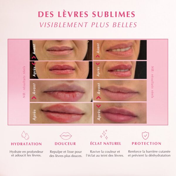 Resultats avant apres du traitement des levres par IALIDRA Sweetlips